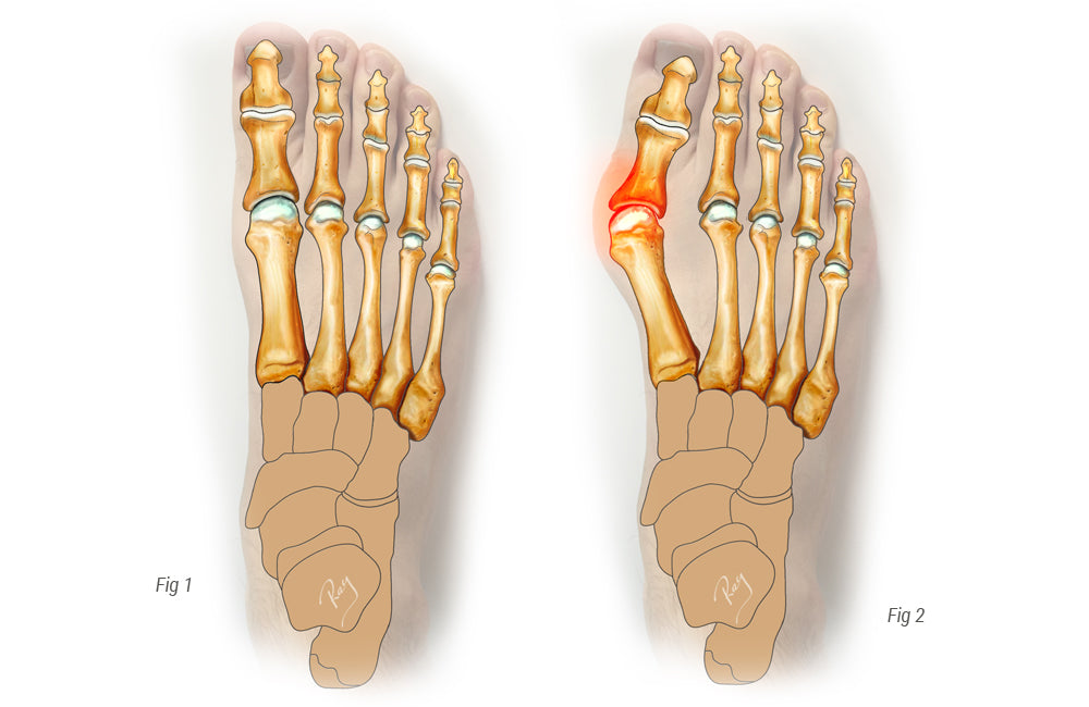 Hallux valgus