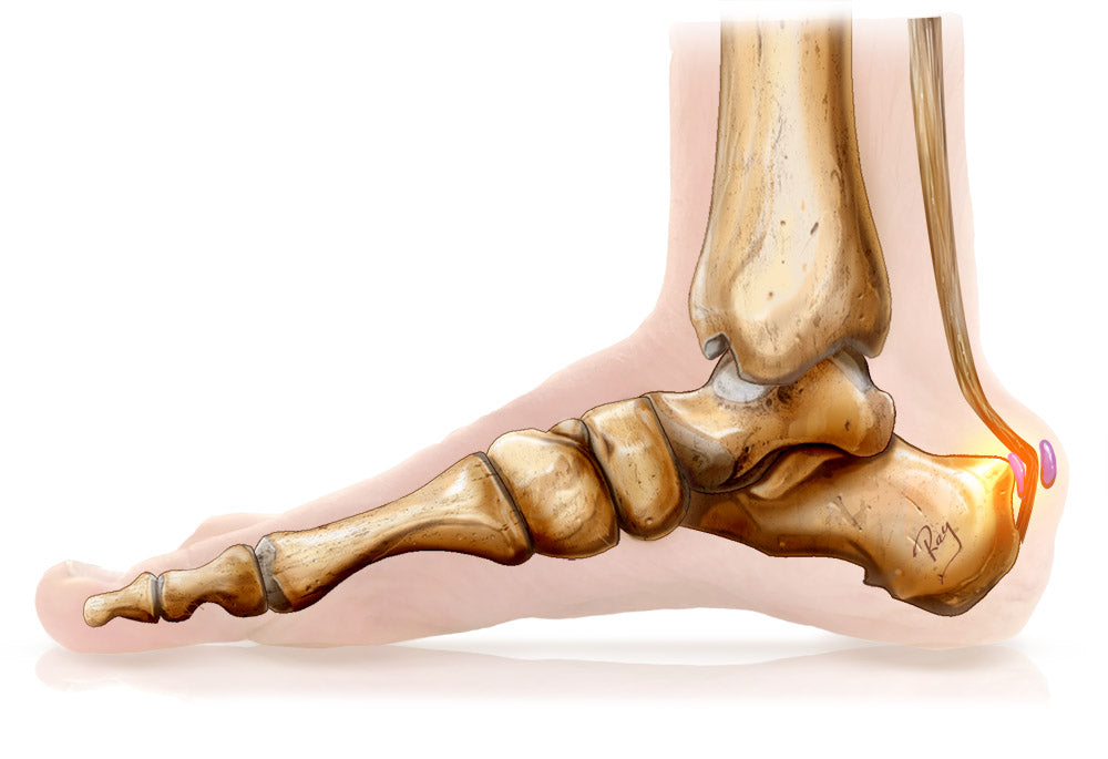 Haglund's deformity