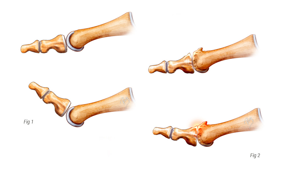 Hallux rigidus
